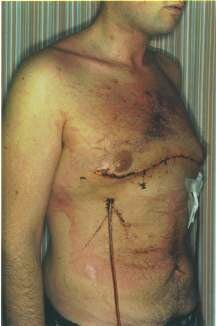 Ravitch - Pectus Carinatum - 3 Days post-op