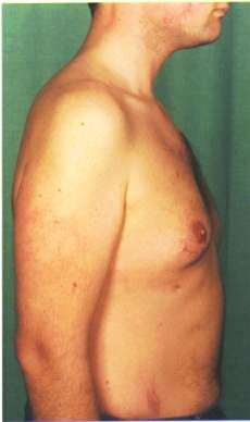 Ravitch - Pectus Carinatum - 6 Weeks post-op