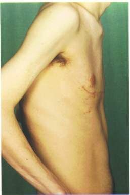 Ravitch - Pectus Excavatum - 6 Weeks post-op