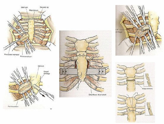 Ravitch Procedure